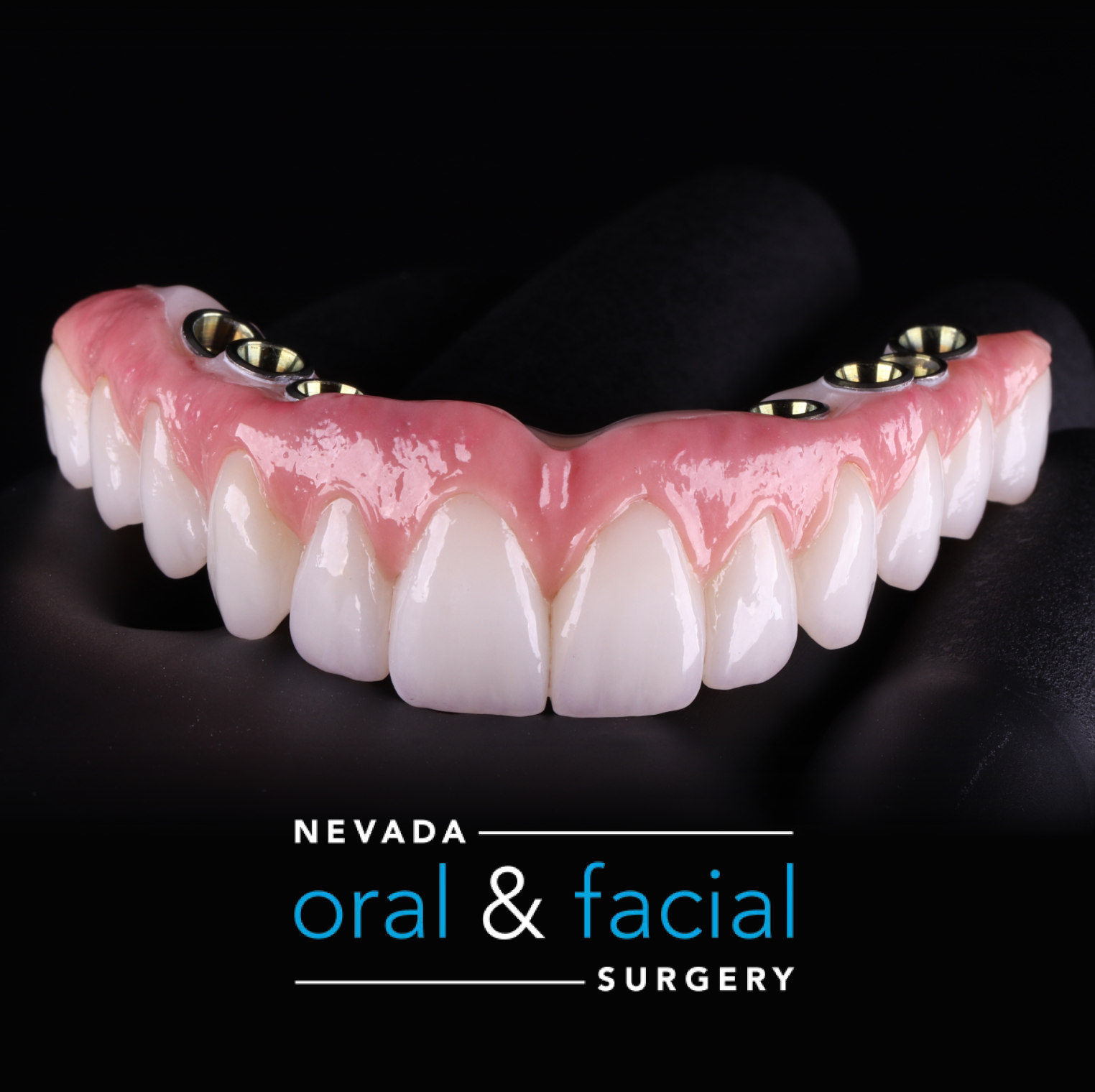 Hybrid Implant Bridge