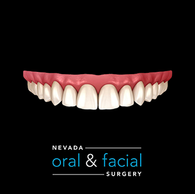 Zirconia Implant Bridge