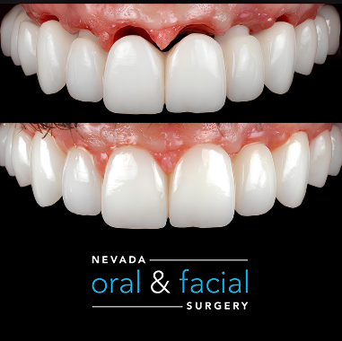 Porcelain Implant Bridge